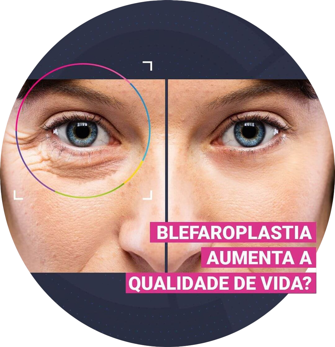 mira hospital oftalmologico blefaroplastia